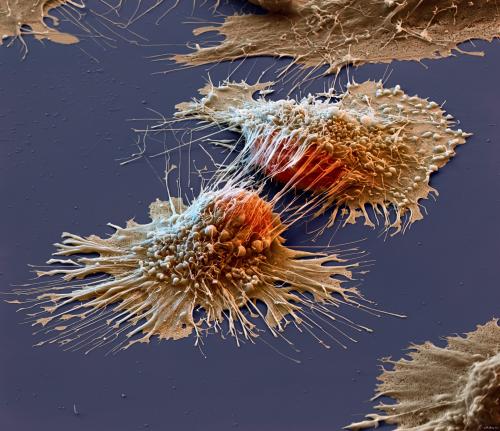 Симптомы рака, которые появляются за 5 лет до заболевания, назвали онкологи