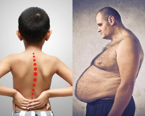 Горбатый жирдяй: Врачи назвали причину появления сколиоза у детей