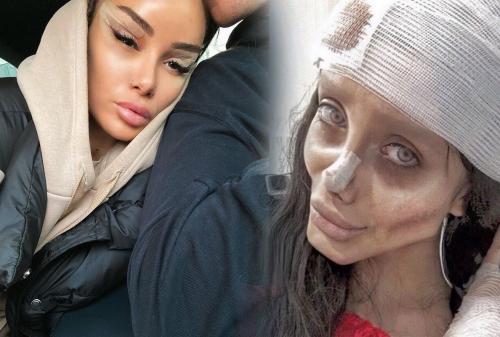 «Хочется плакать»: Айза превратилась в зомби-копию Джоли после пластики лица